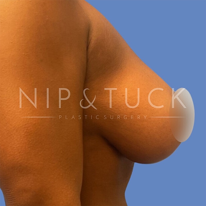 Breast Augmentation Before & After