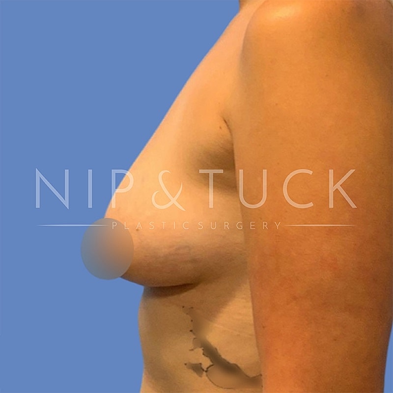 Breast Augmentation Before & After