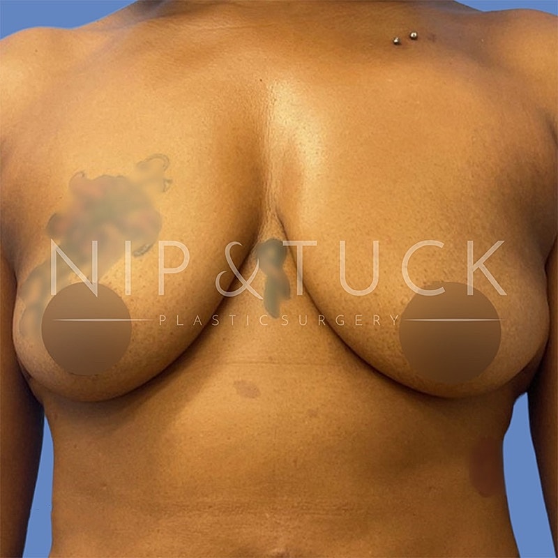 Breast Augmentation Before & After