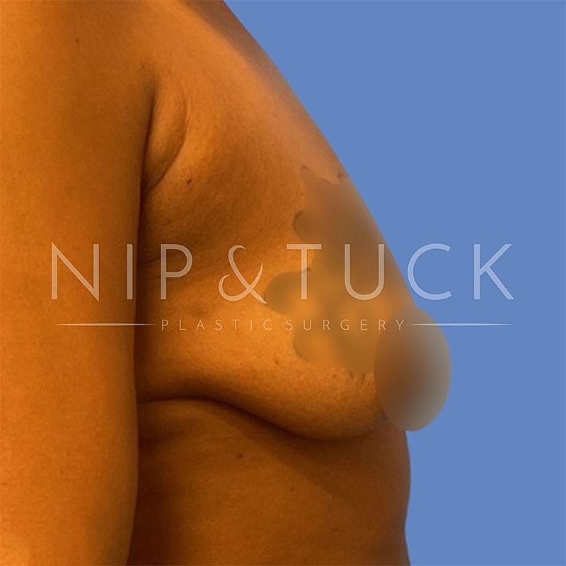 Breast Augmentation Before & After