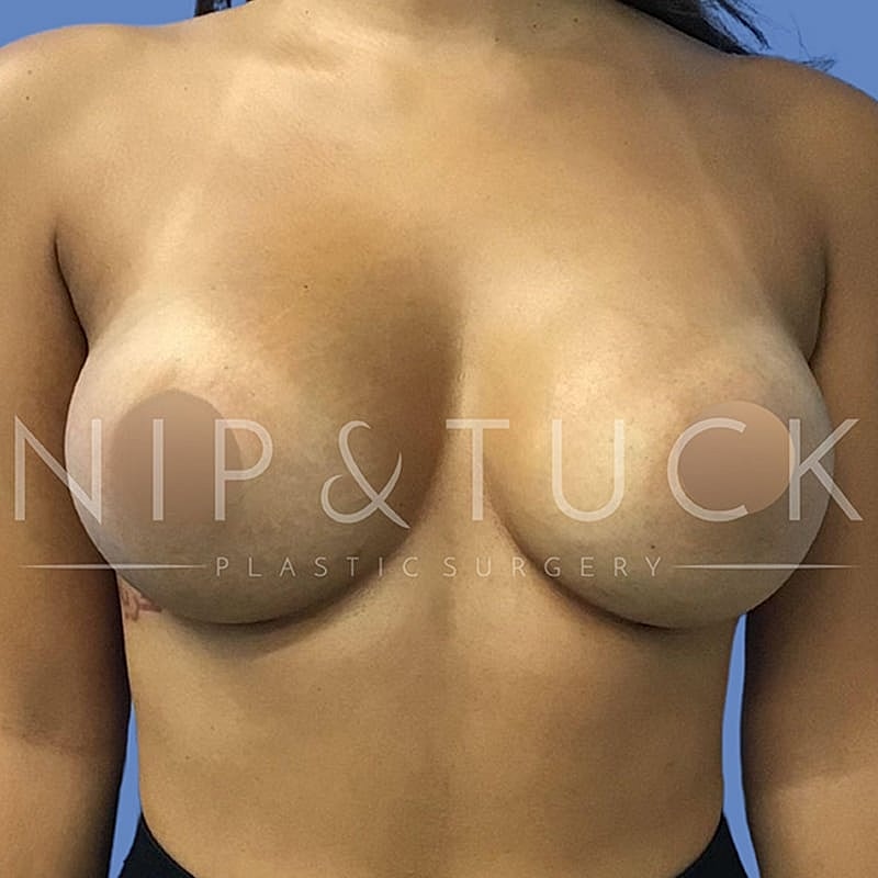 Breast Augmentation Before & After