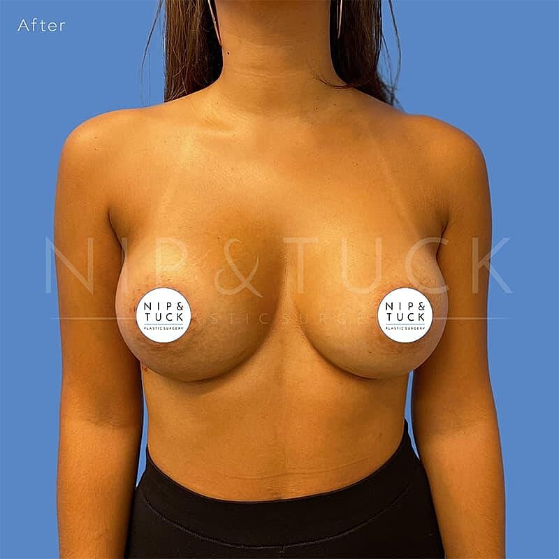 Breast Augmentation Before & After