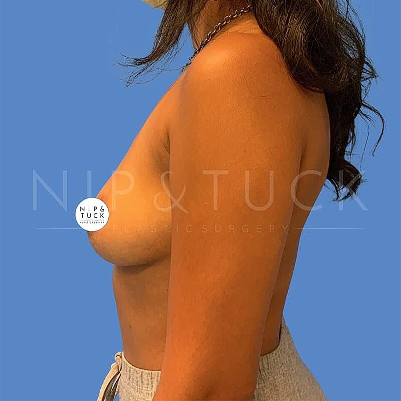 Breast Augmentation Before & After