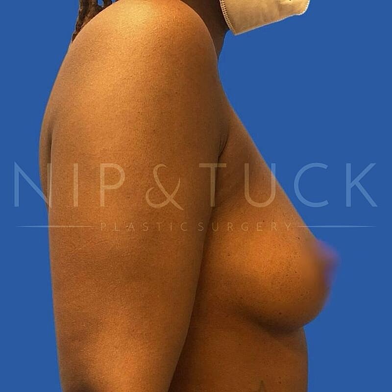 Breast Augmentation Before & After