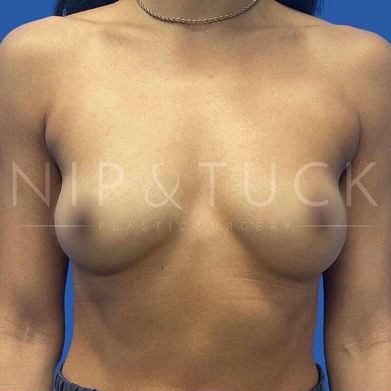 Breast Augmentation Before & After