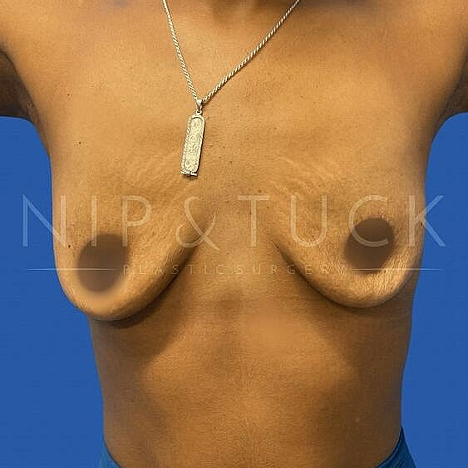 Breast Augmentation Before & After