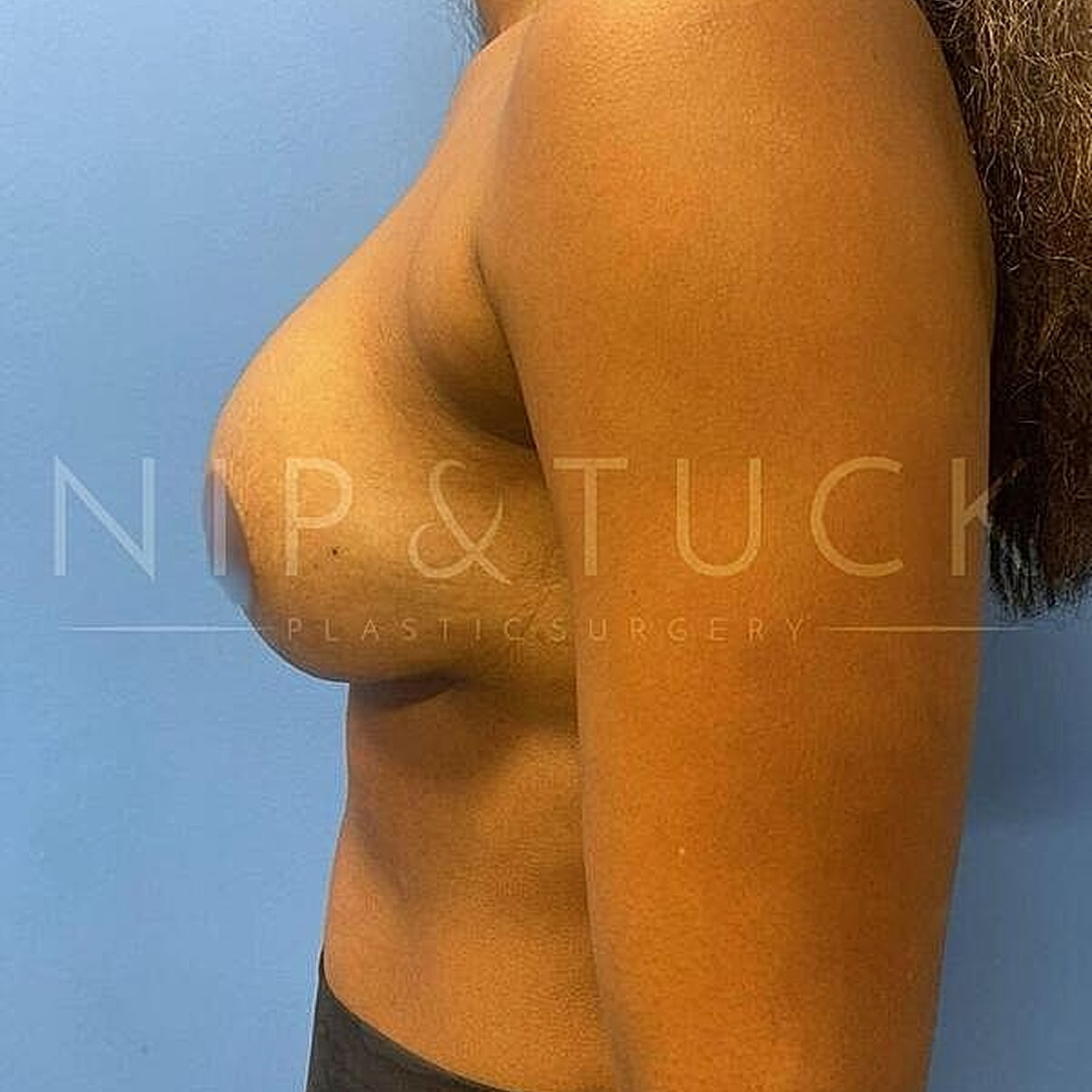 Breast Augmentation Before & After