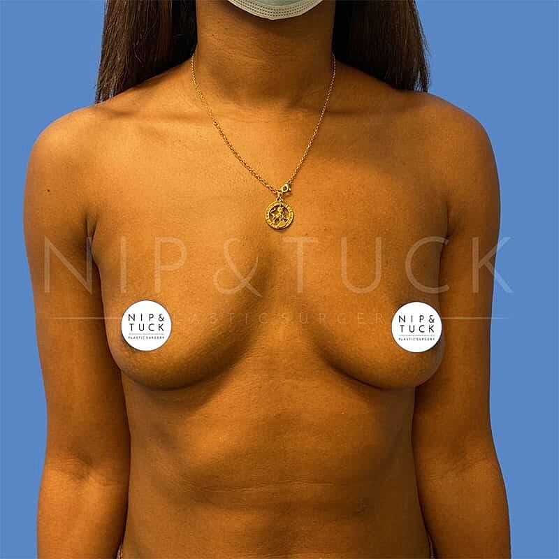 Breast Augmentation Before & After