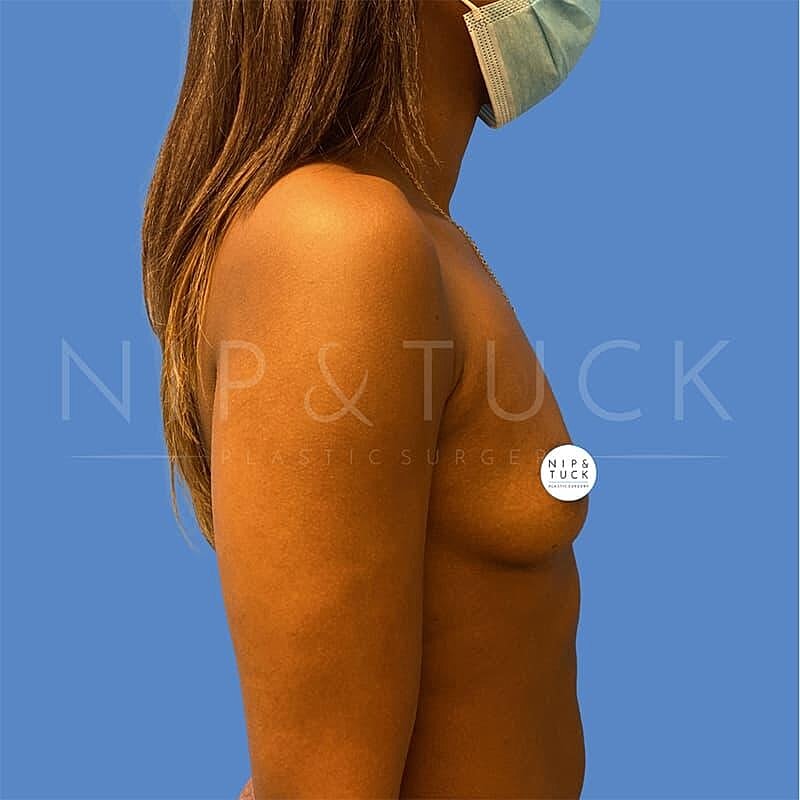 Breast Augmentation Before & After