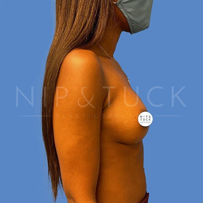 Breast Augmentation Before & After