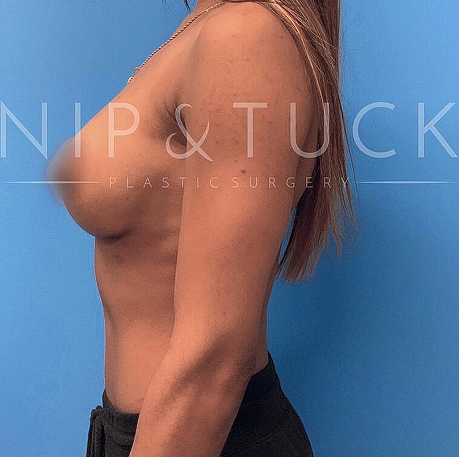 Breast Augmentation Before & After