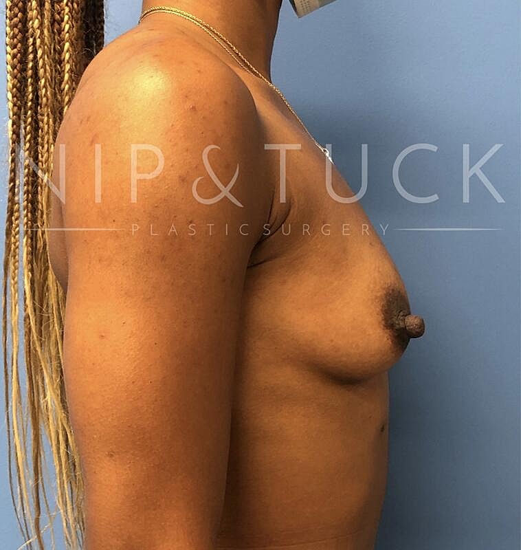 Breast Augmentation Before & After