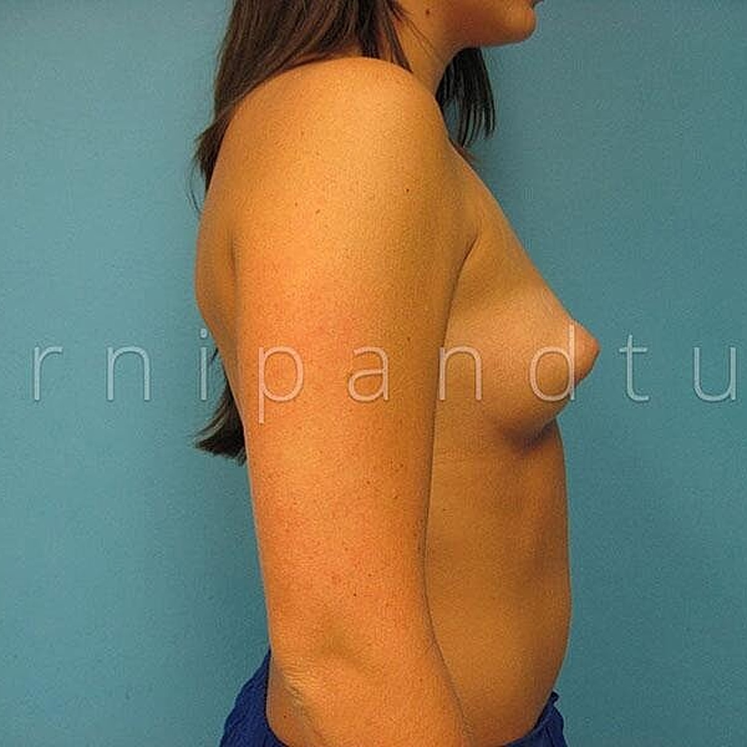 Breast Augmentation Before & After