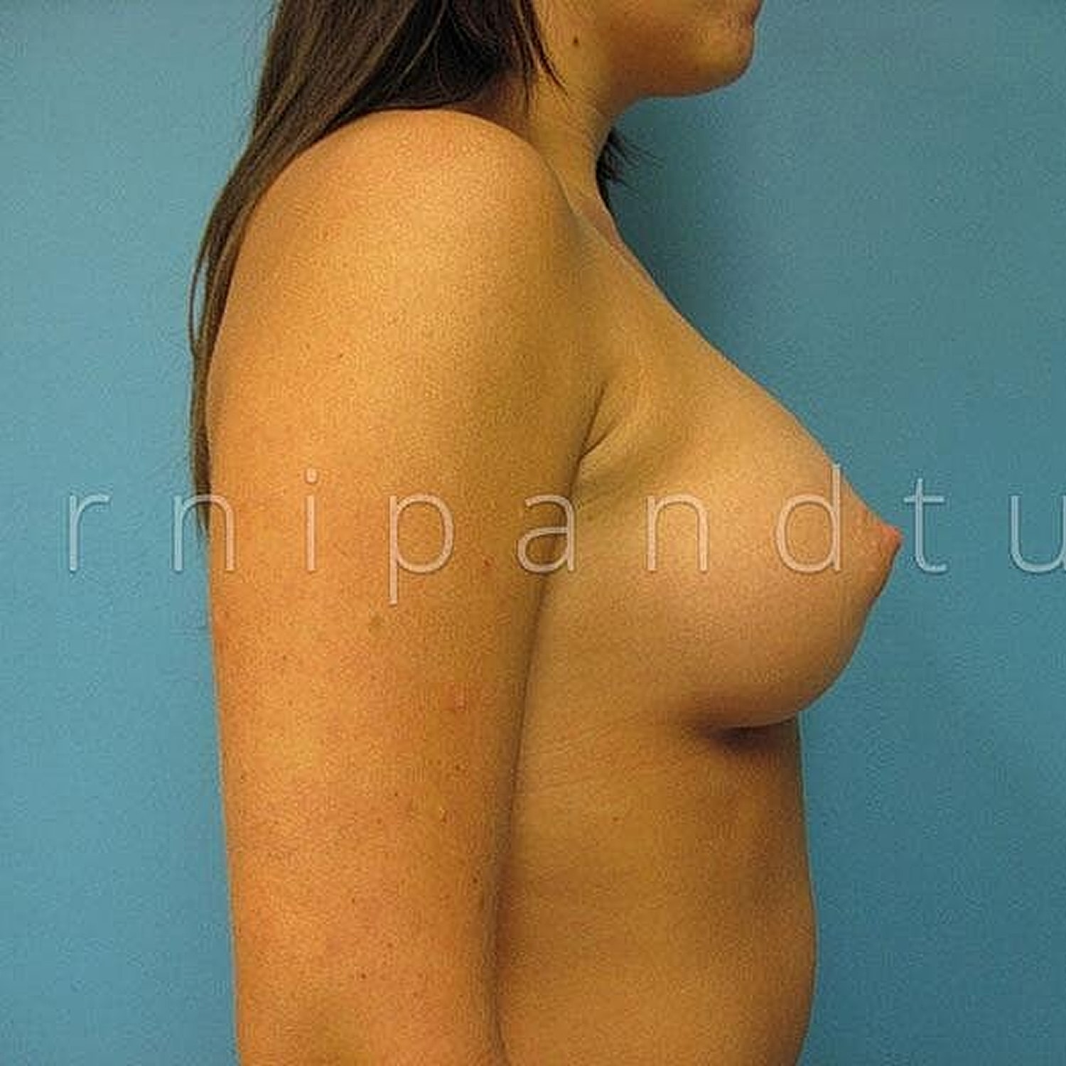 Breast Augmentation Before & After