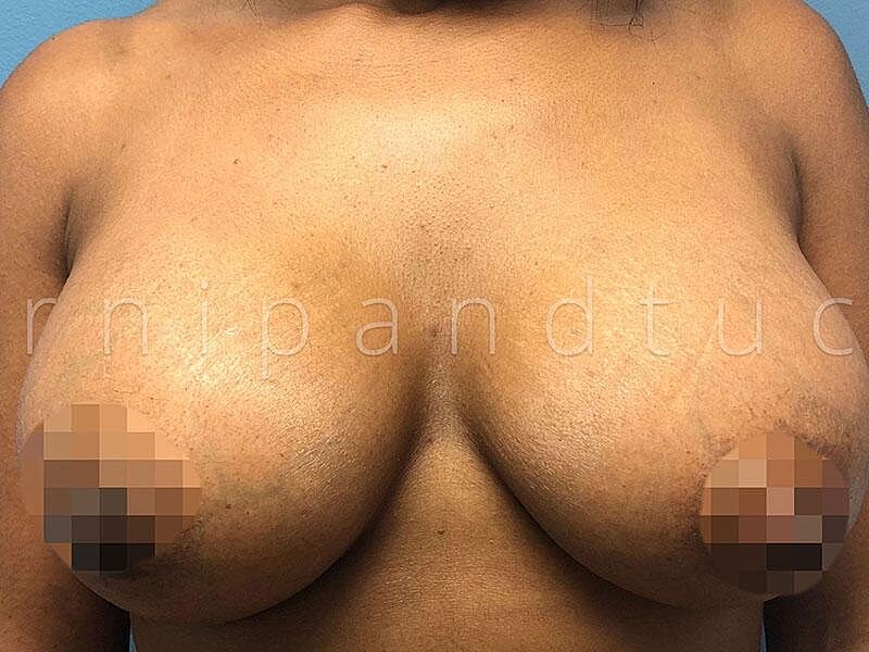 Breast Augmentation Before & After