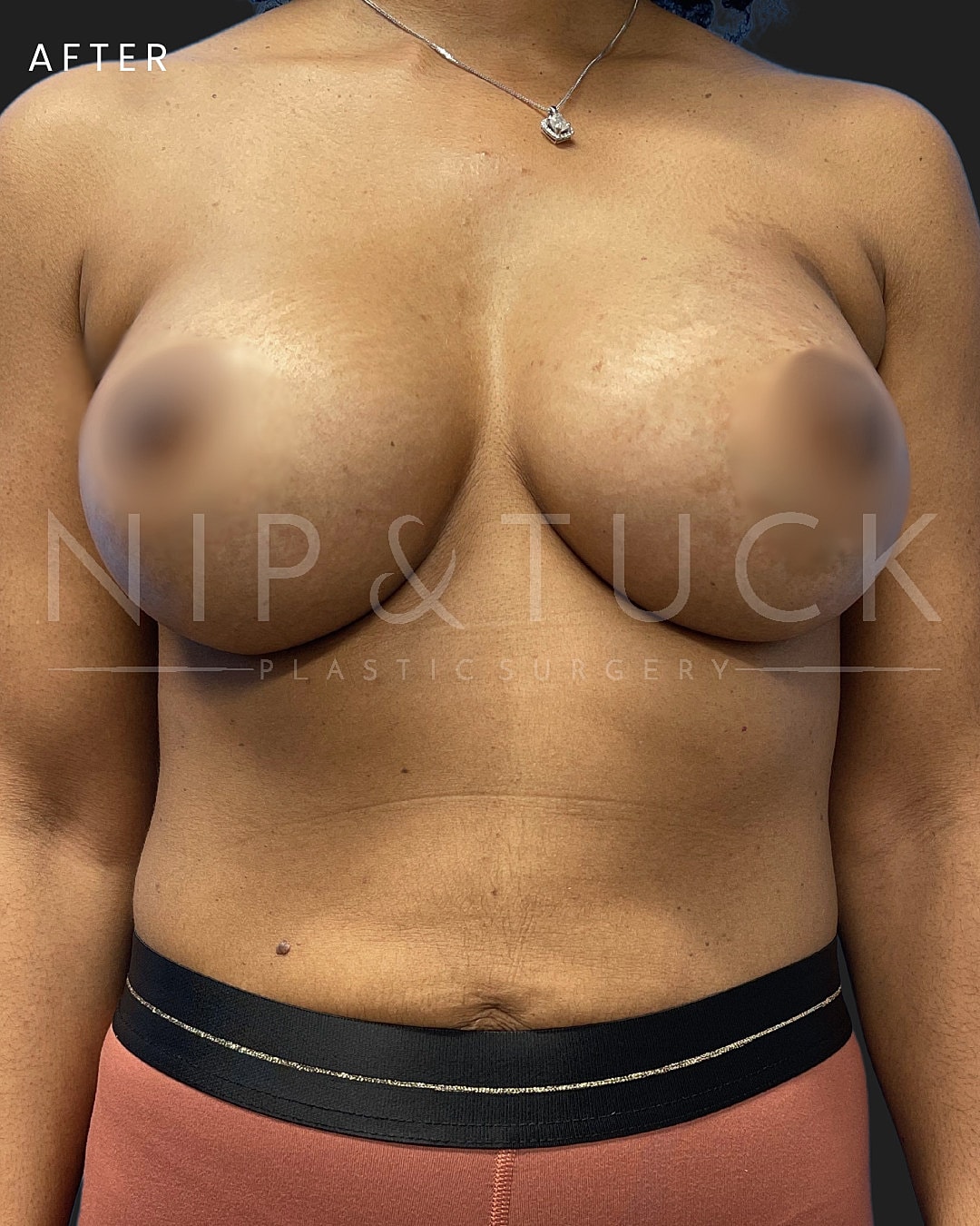 Breast Augmentation Before & After