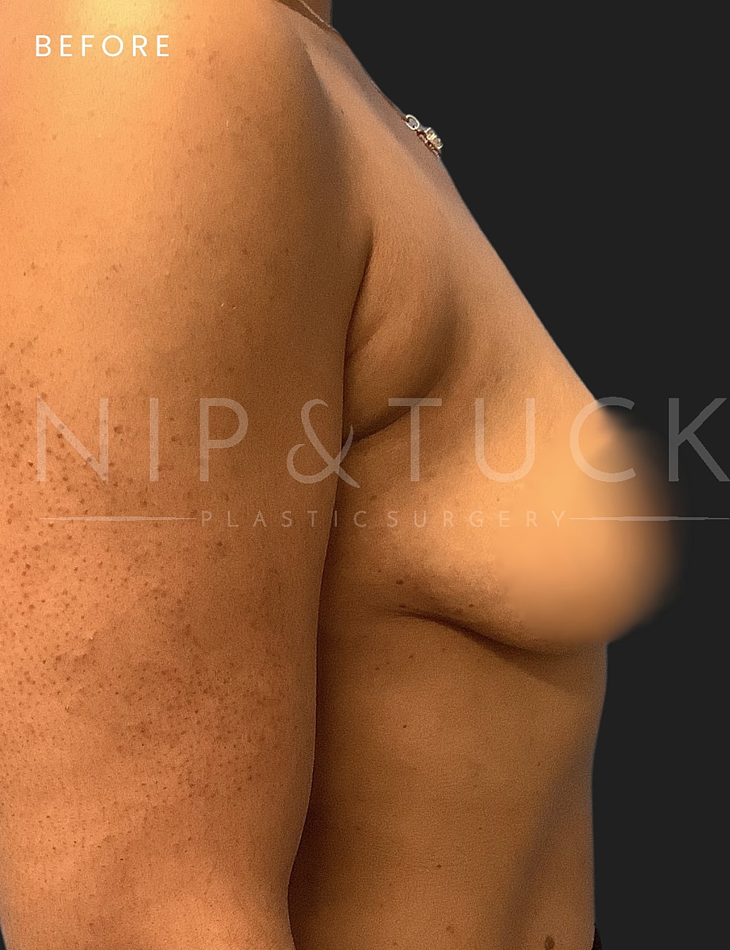 Breast Augmentation Before & After
