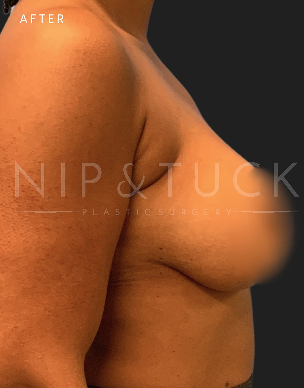 Breast Augmentation Before & After
