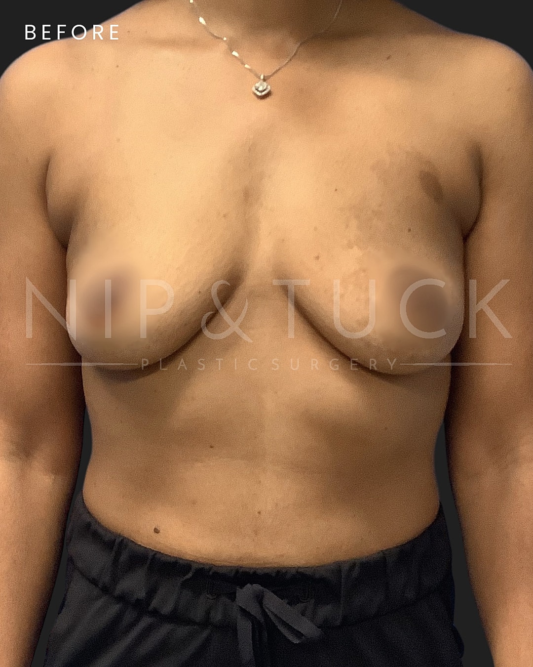 Breast Augmentation Before & After