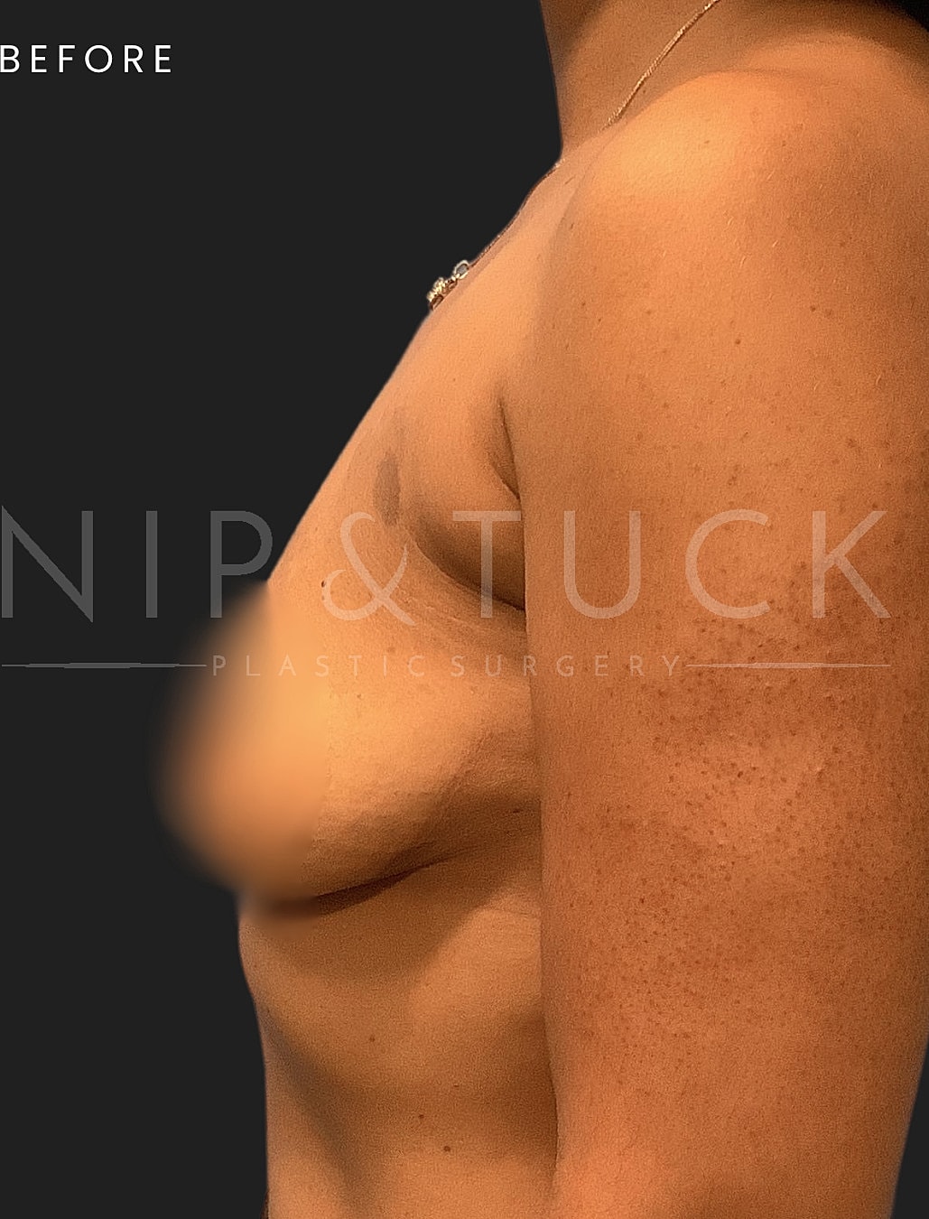 Breast Augmentation Before & After