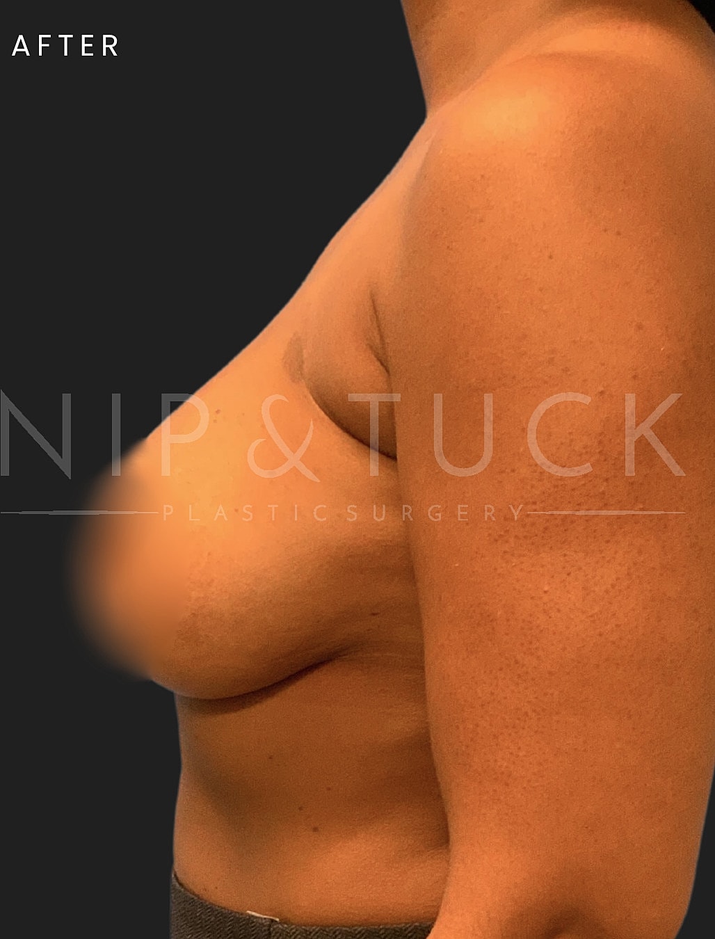 Breast Augmentation Before & After
