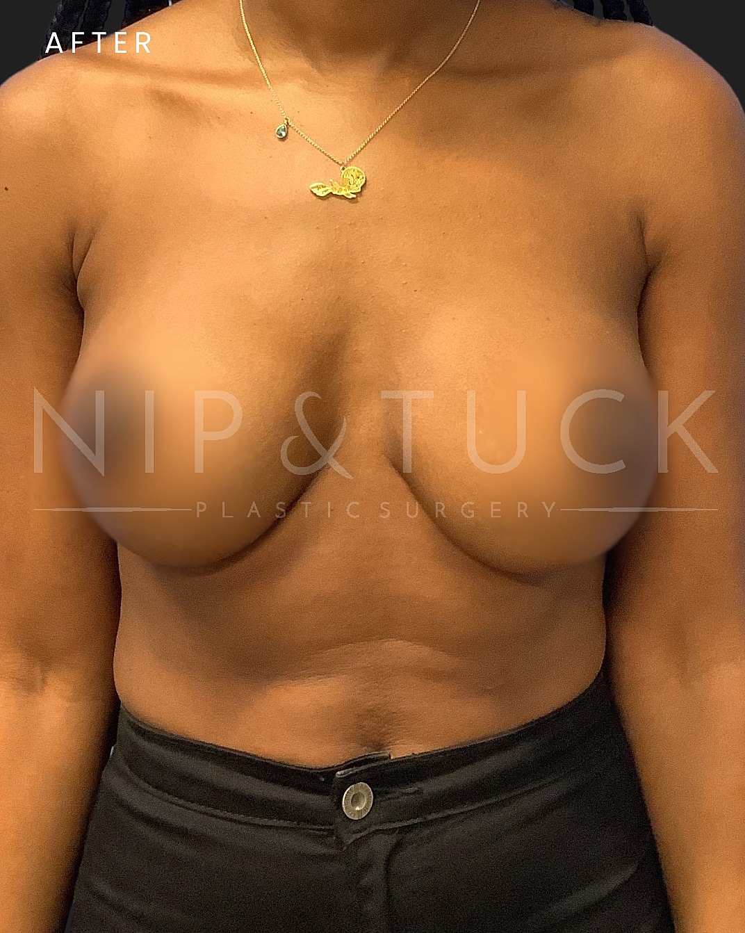 Breast Augmentation Before & After