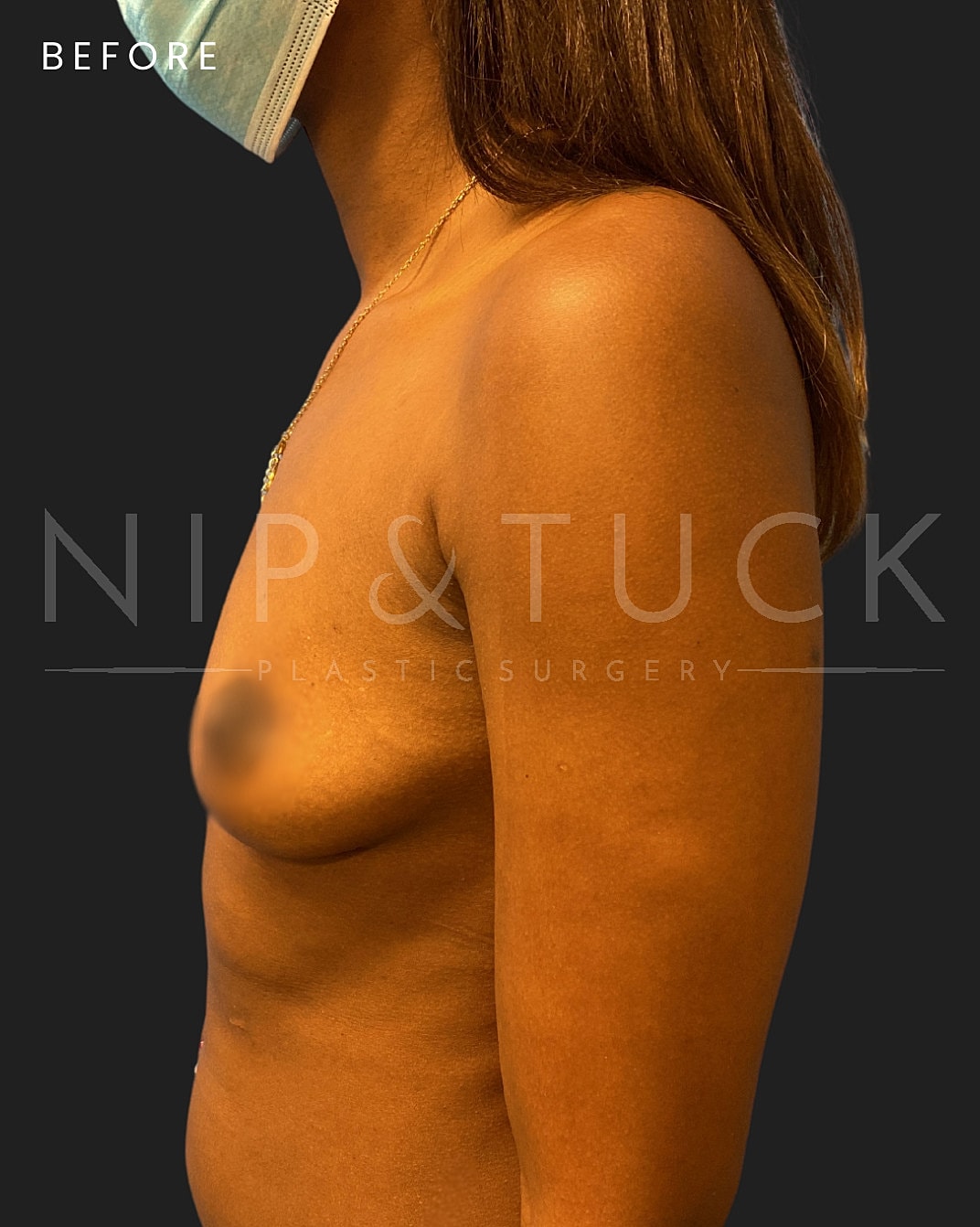 Breast Augmentation Before & After