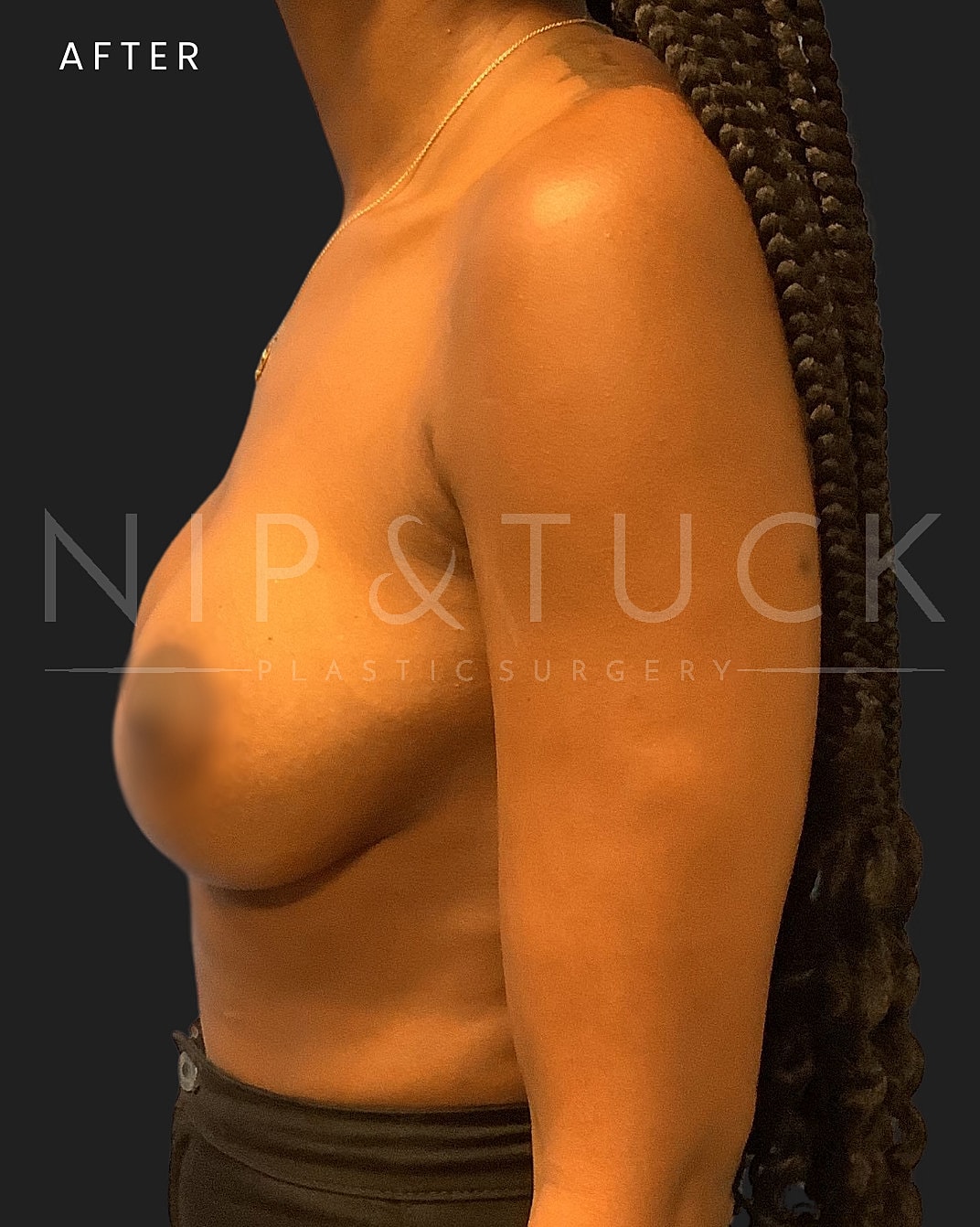 Breast Augmentation Before & After
