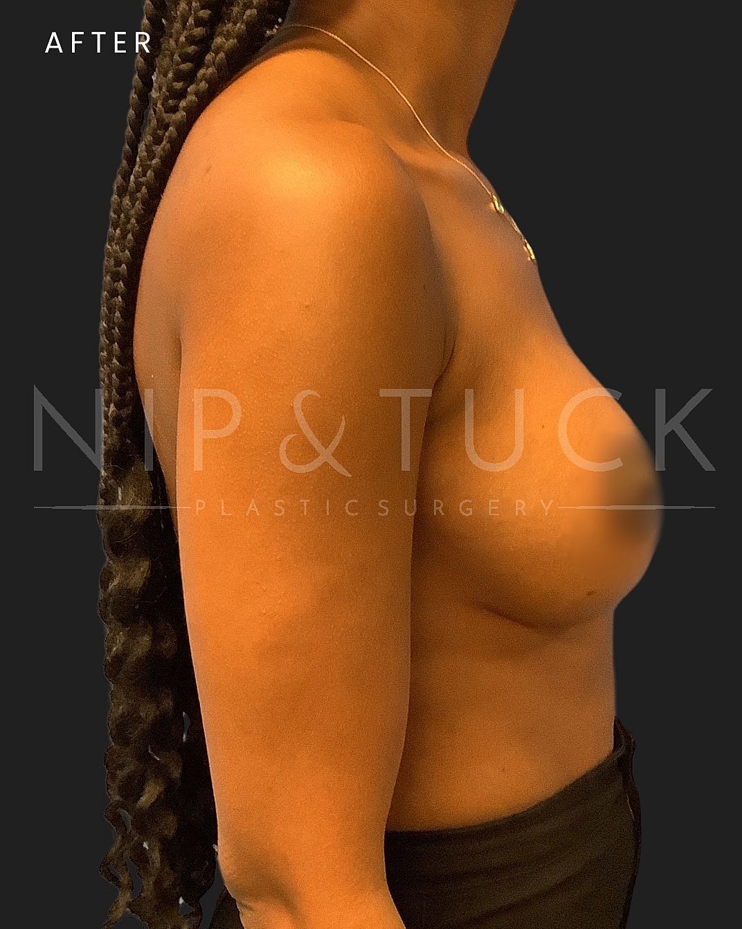 Breast Augmentation Before & After
