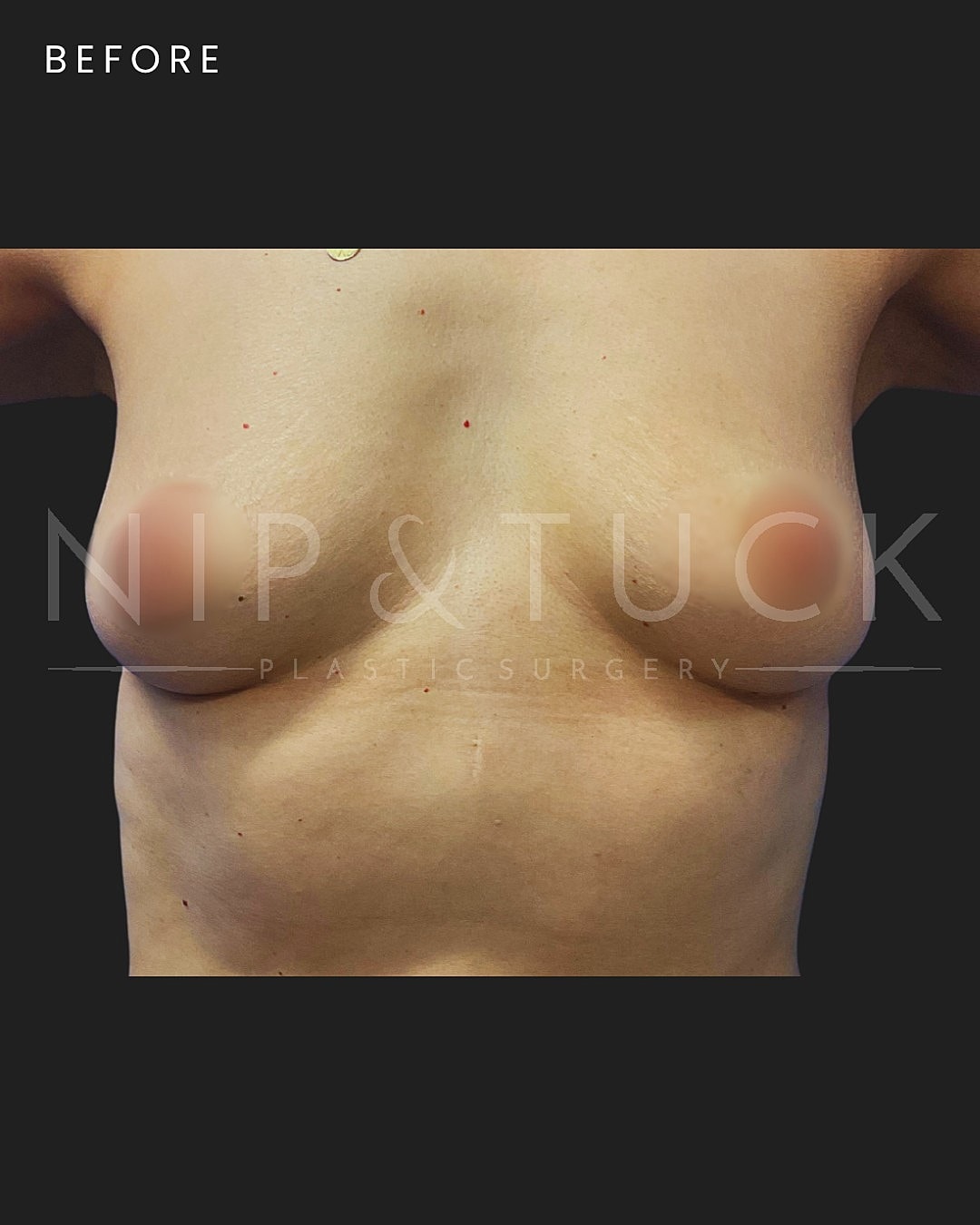 Breast Augmentation Before & After