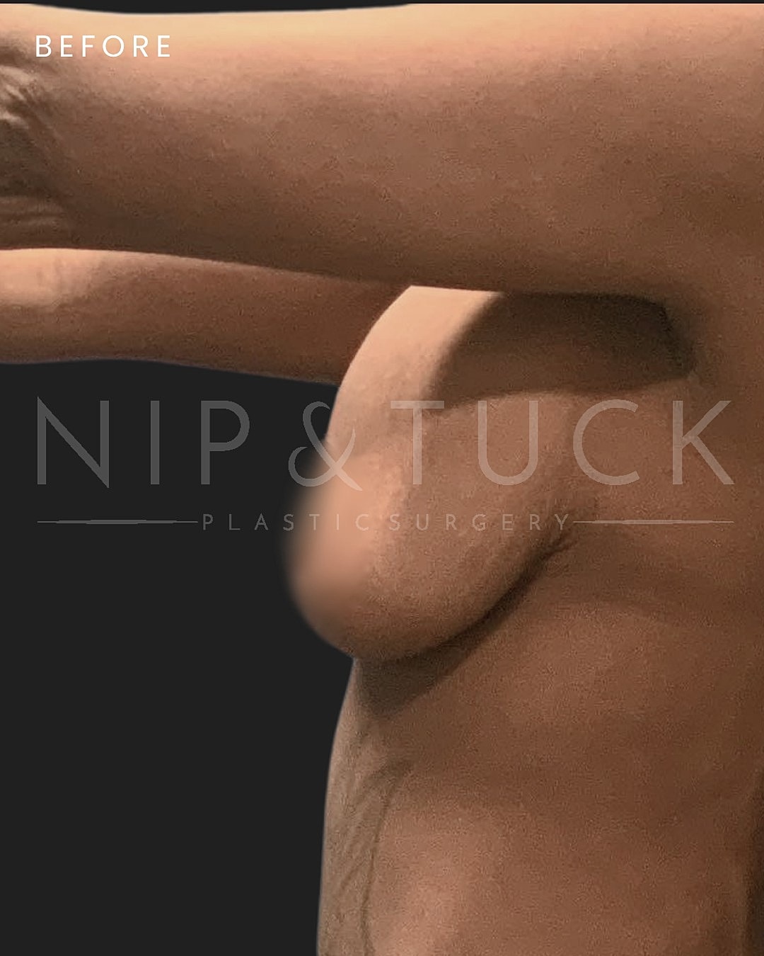 Breast Augmentation Before & After