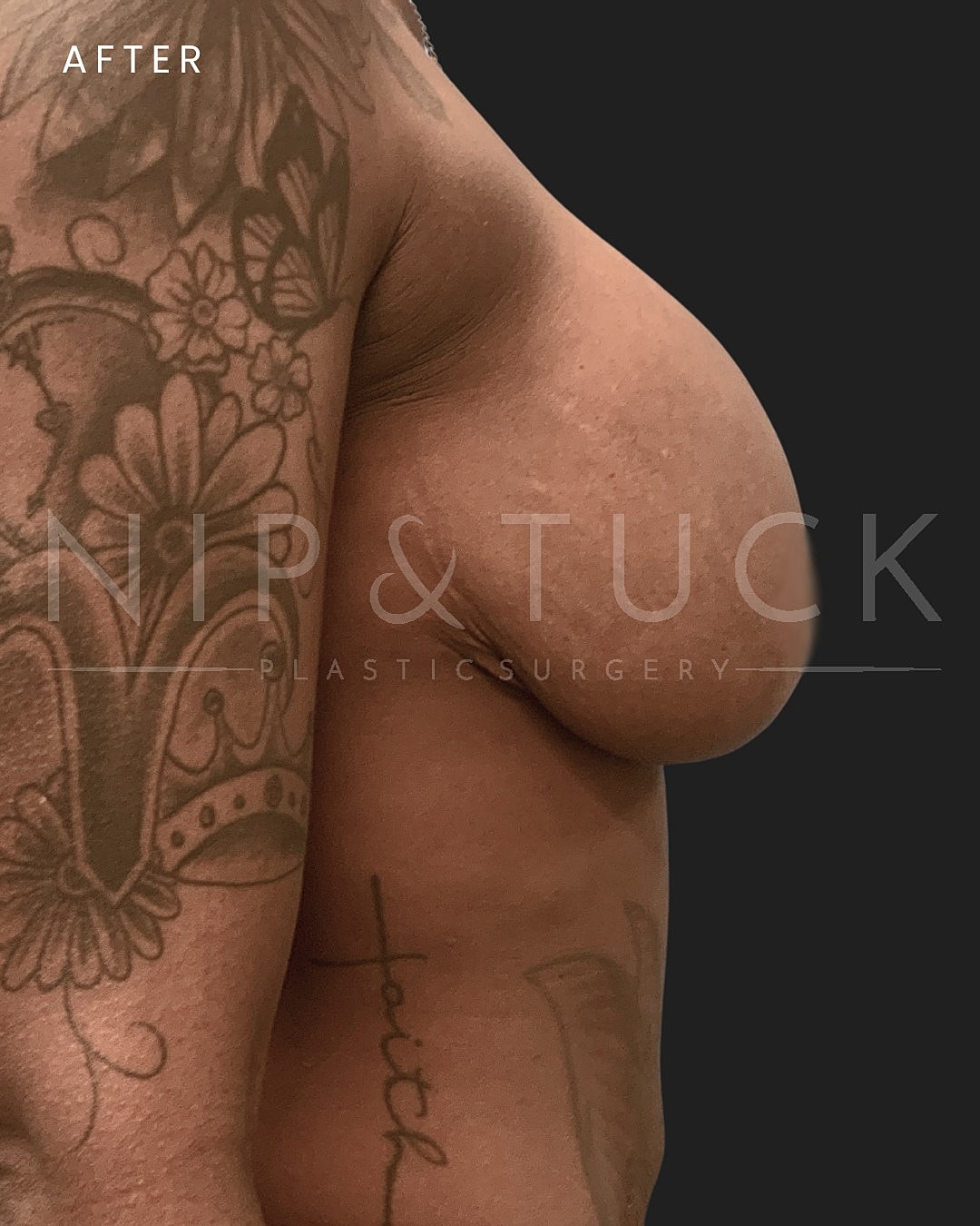Breast Augmentation Before & After