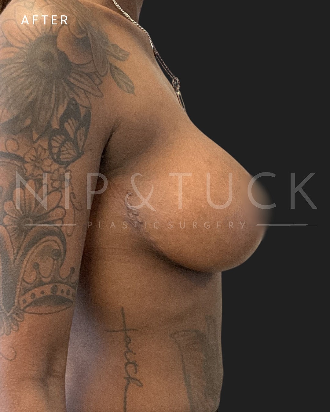 Breast Augmentation Before & After