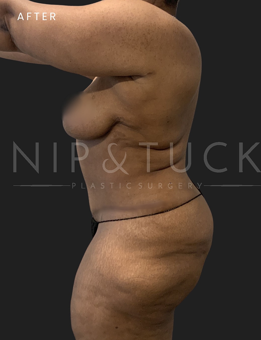 Lipo 360 Before & After