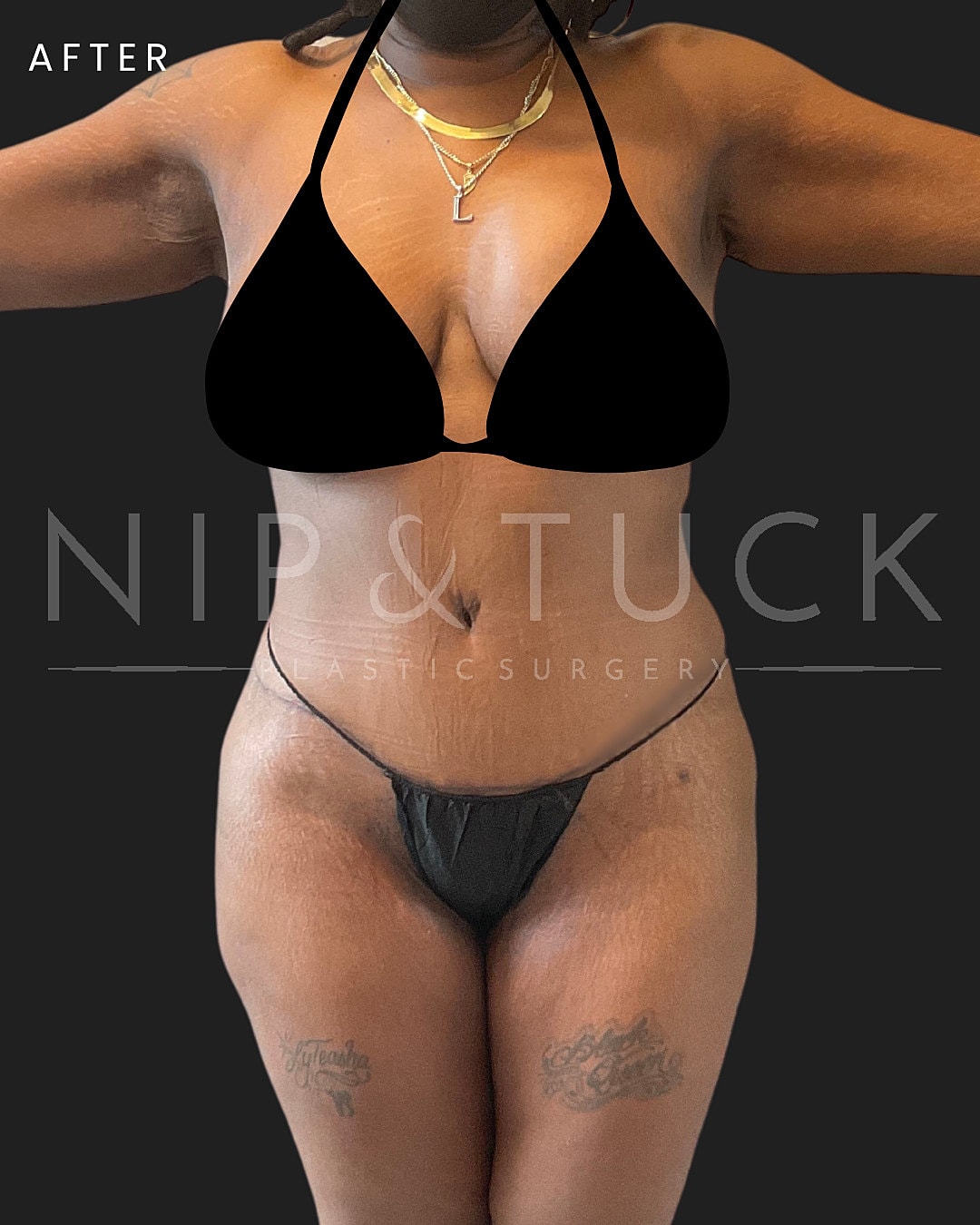 Lipo 360 Before & After