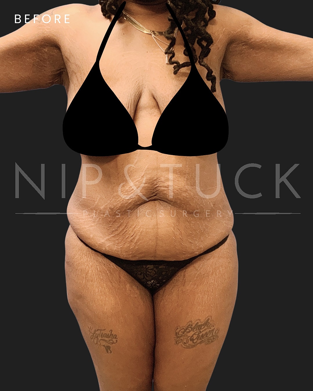 Lipo 360 Before & After