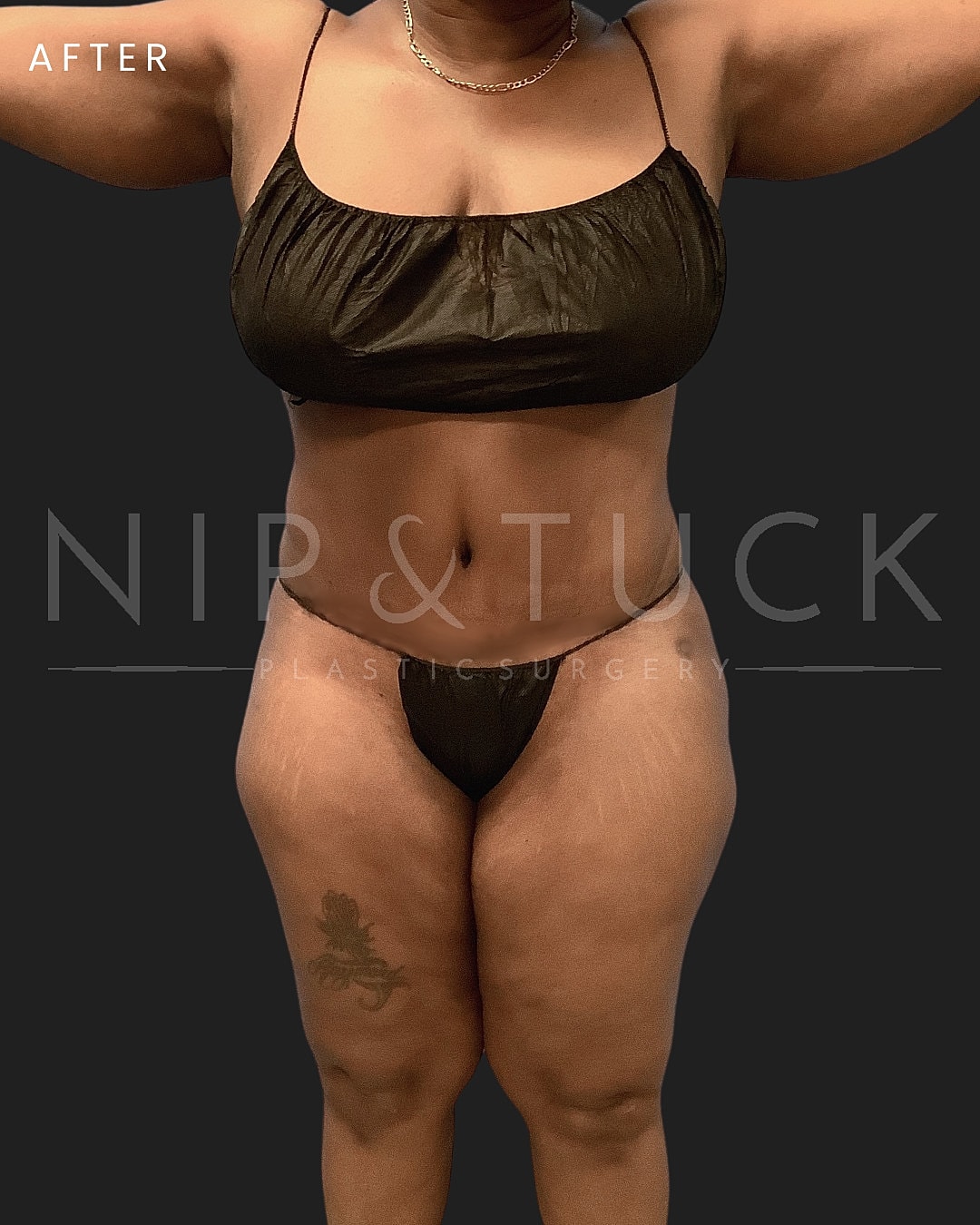 Lipo 360 Before & After