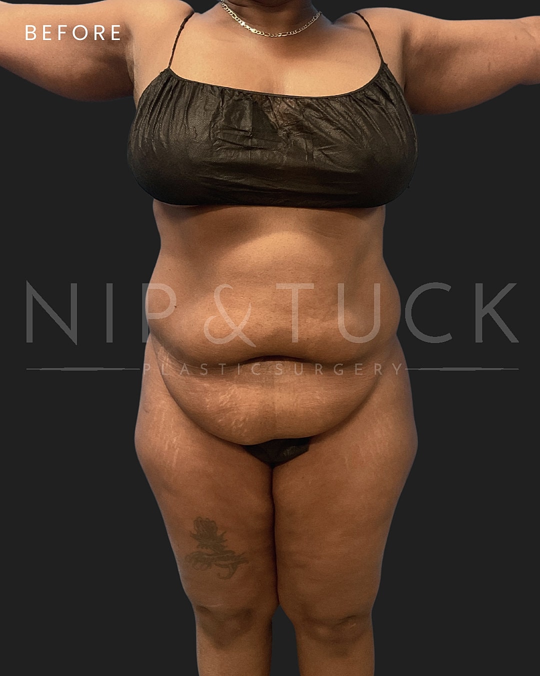 Lipo 360 Before & After