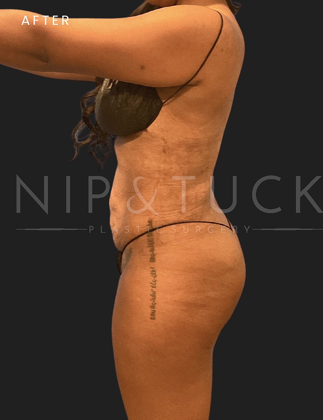 Lipo 360 Before & After