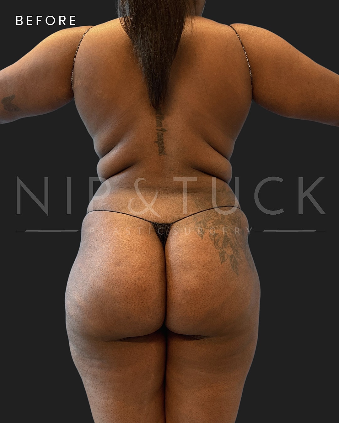 Lipo 360 Before & After