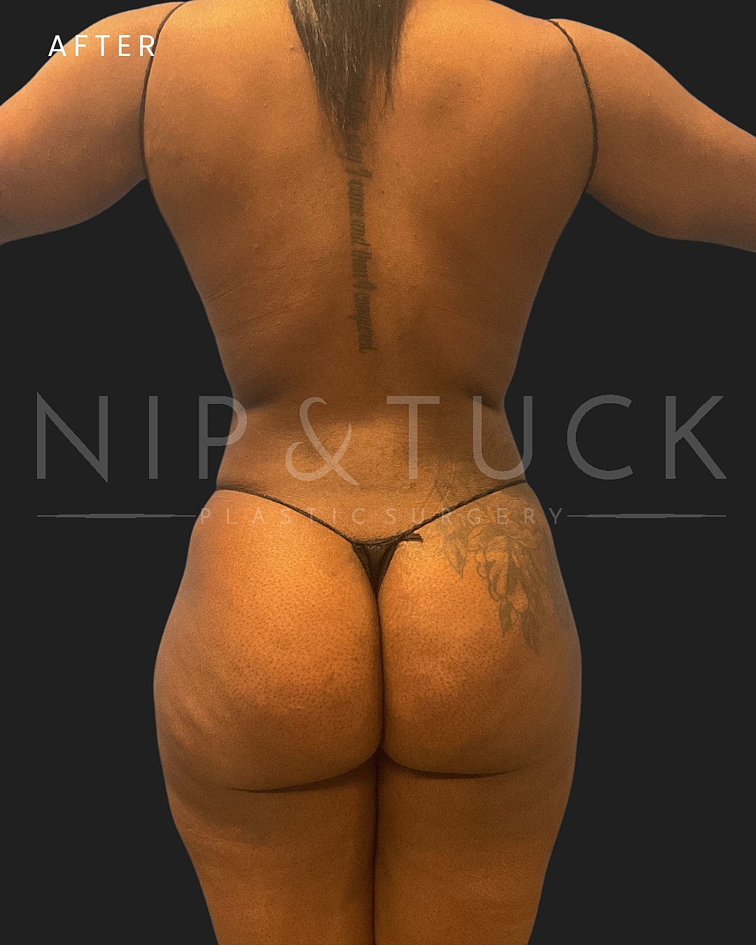 Lipo 360 Before & After