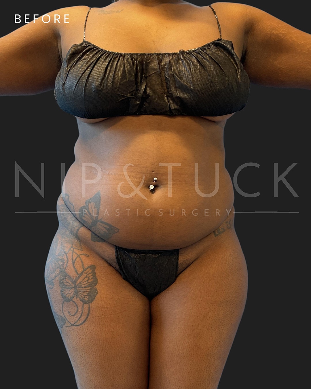 Lipo 360 Before & After