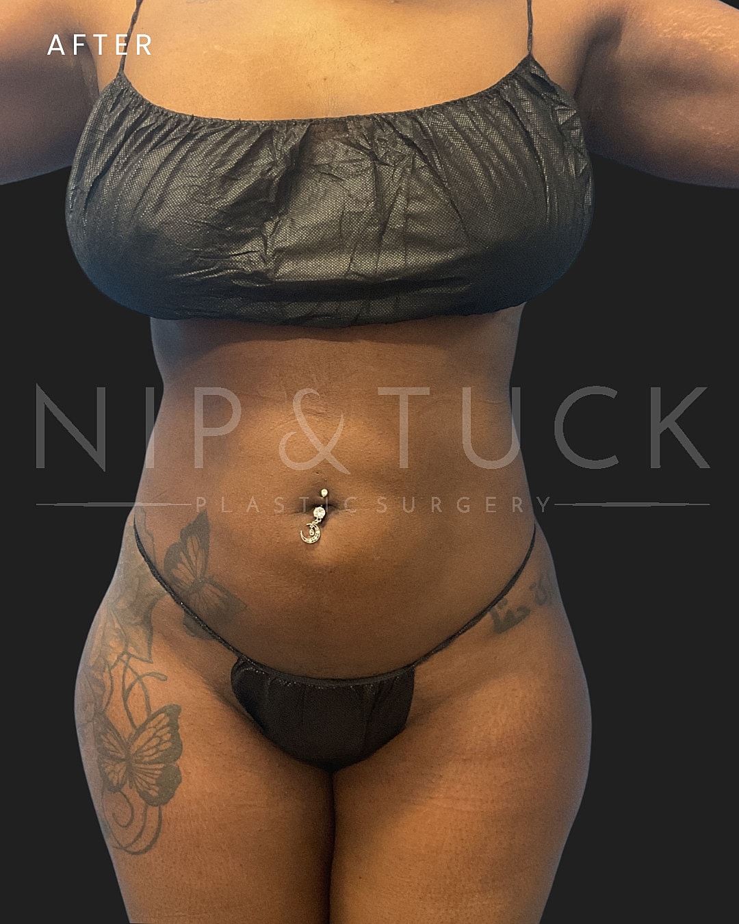 Lipo 360 Before & After