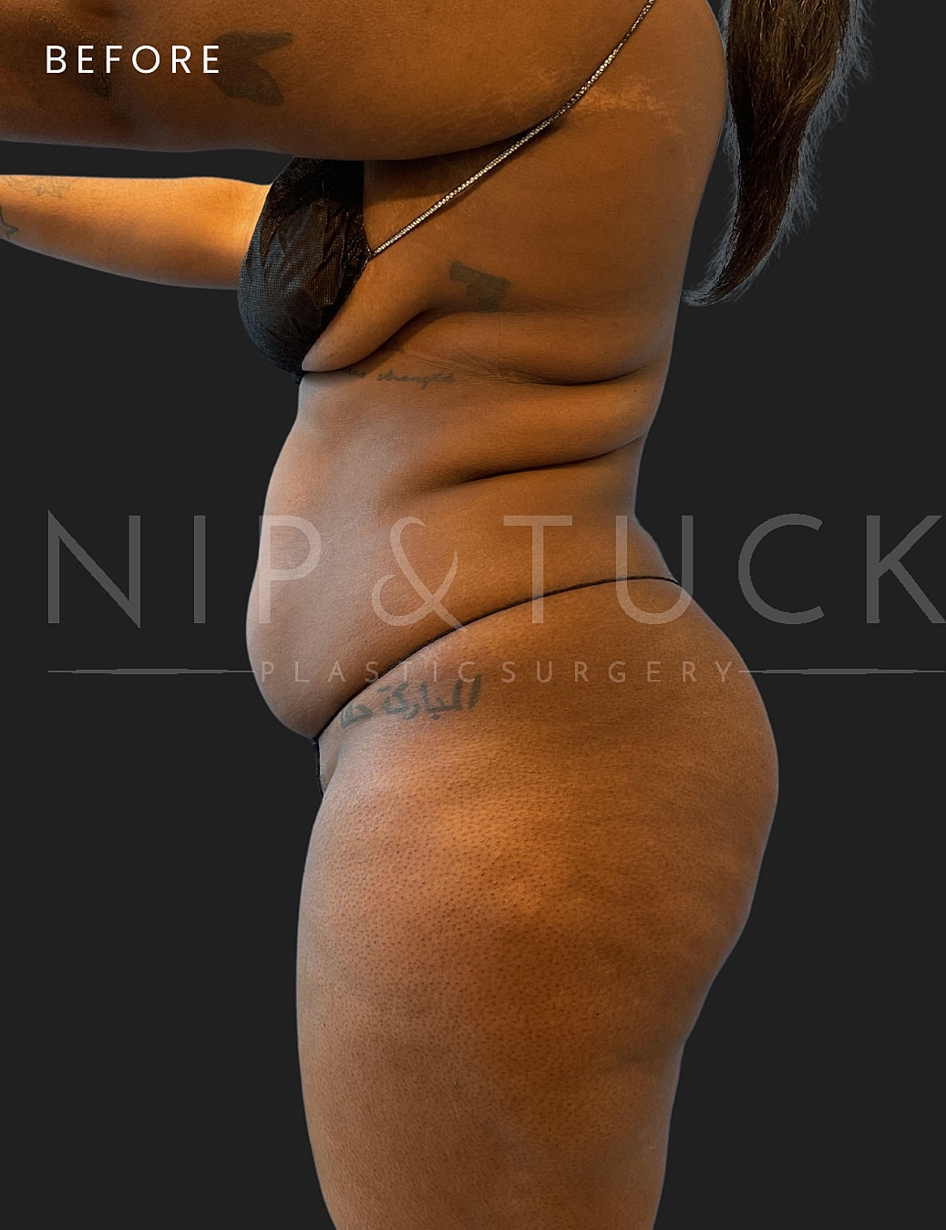 Lipo 360 Before & After