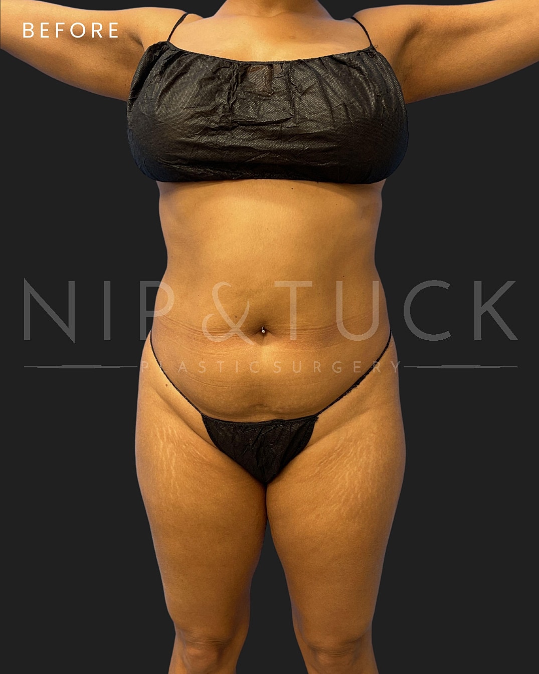 Lipo 360 Before & After