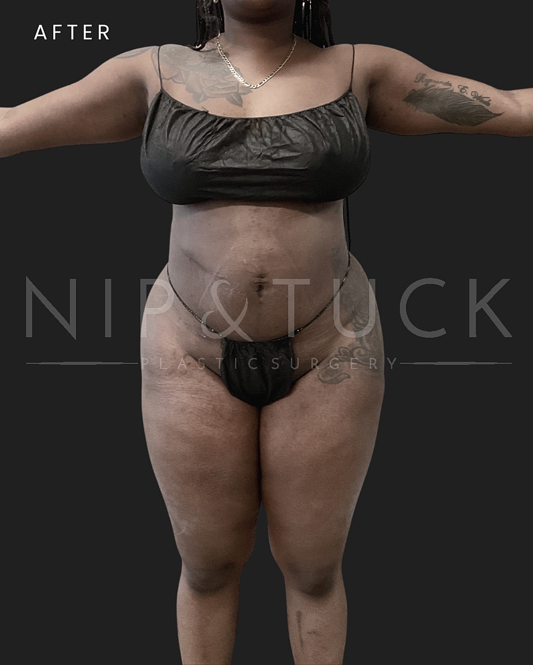 Lipo 360 Before & After