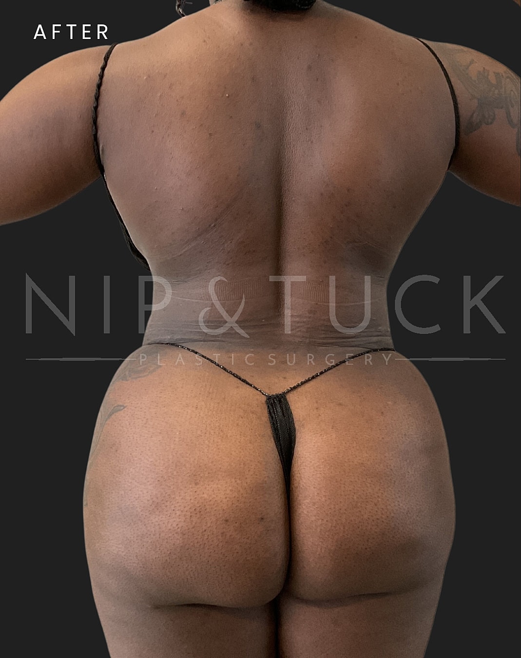 Lipo 360 Before & After