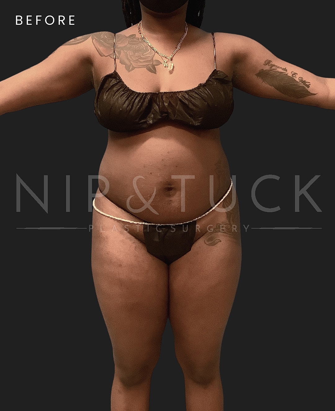Lipo 360 Before & After
