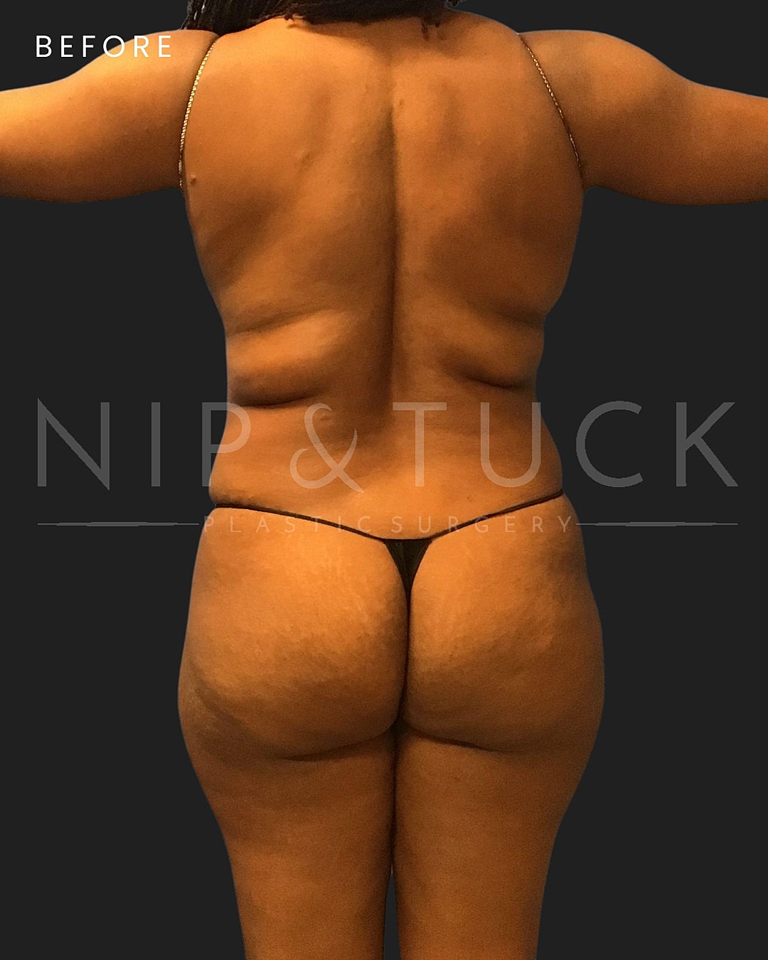 Lipo 360 Before & After