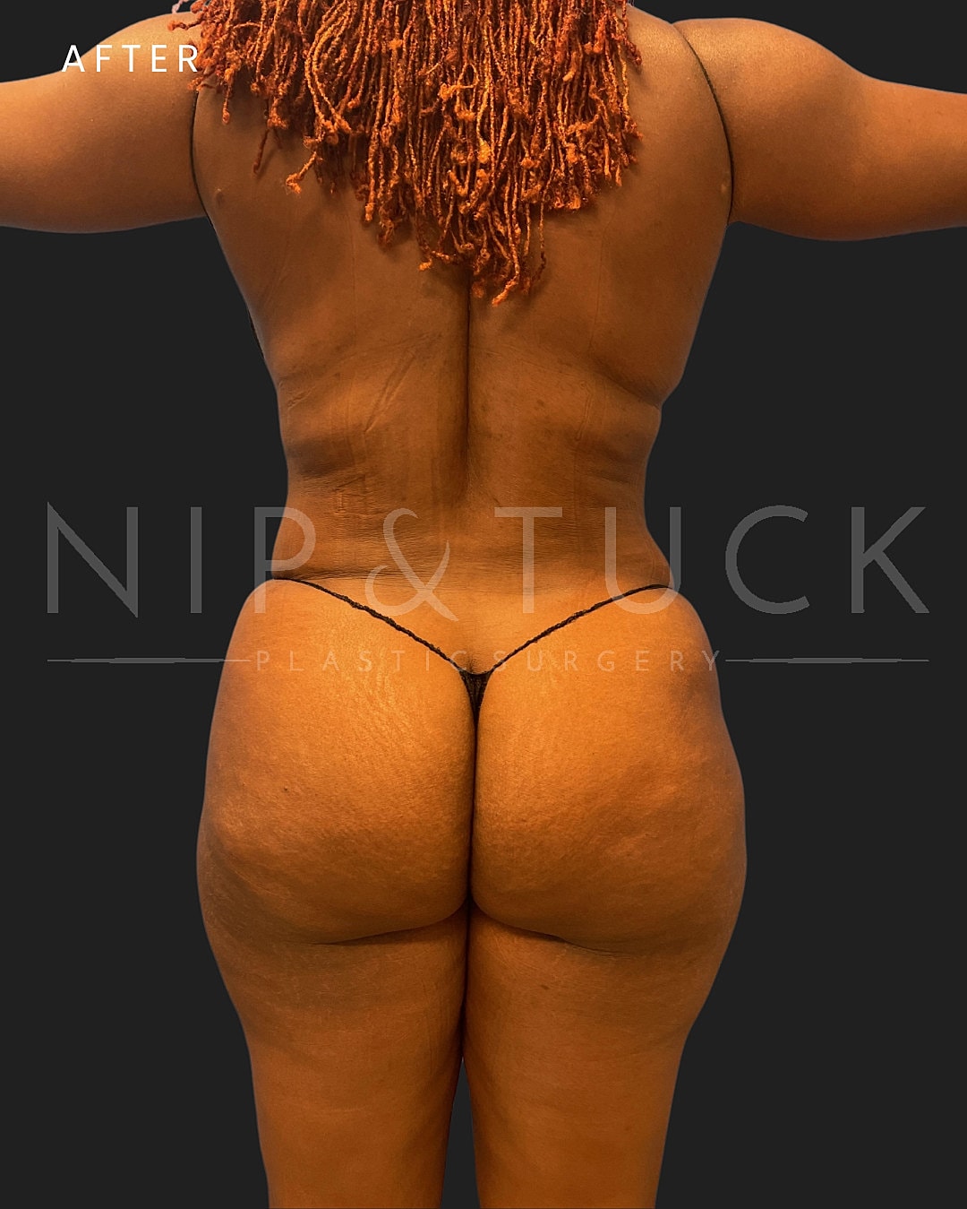 Lipo 360 Before & After